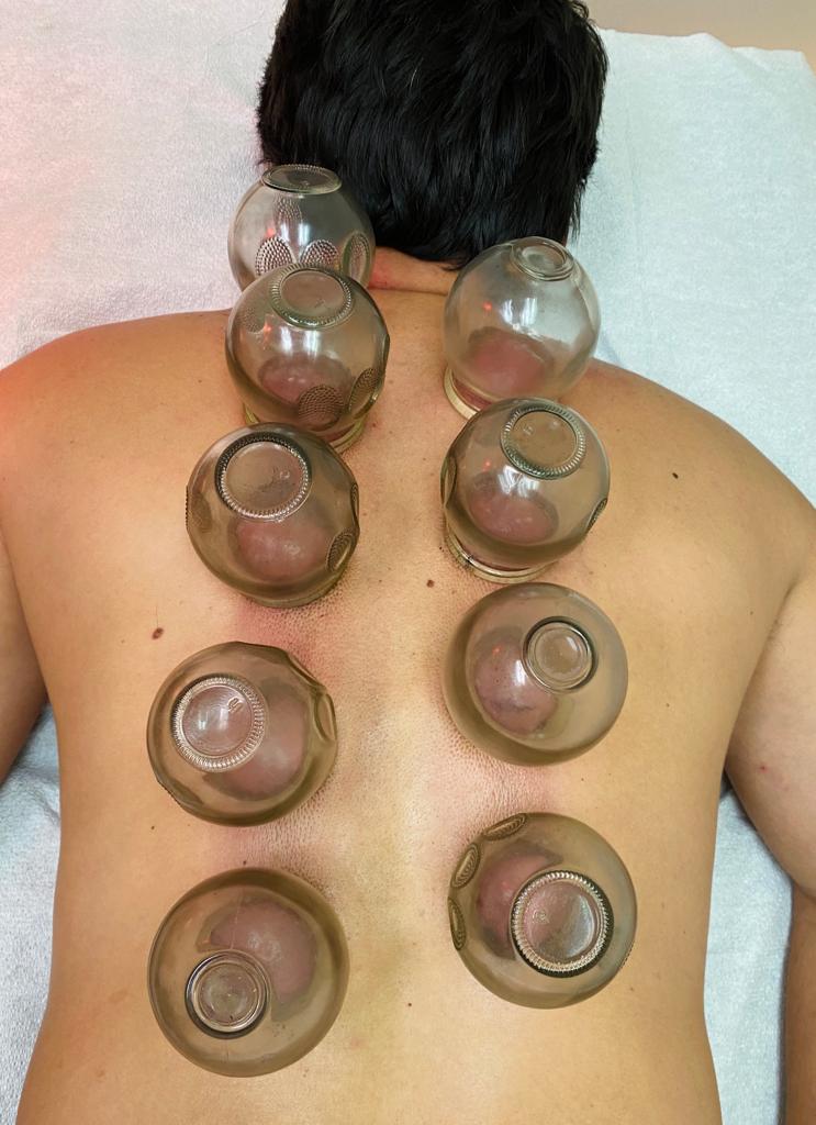 The holistic therapy fort lauderdale treatment involves cupping therapy using glass bottles on the back of a man. atma acupuncture