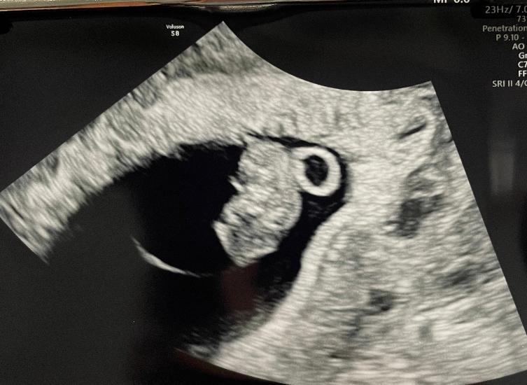 An ultrasound image of a baby's heart, used in fetal cardiology screenings. atma acupuncture