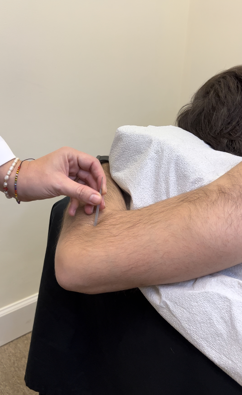 A doctor performing acupuncture on a patient's arm. atma acupuncture