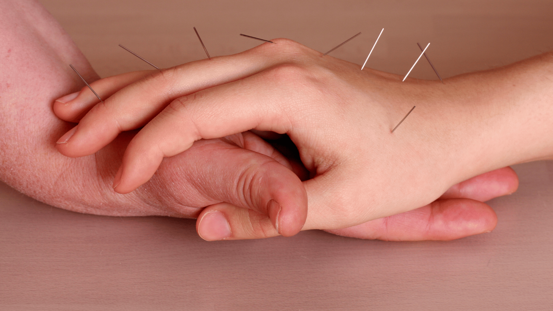 A person's hand undergoing acupuncture therapy in Fort Lauderdale. atma acupuncture