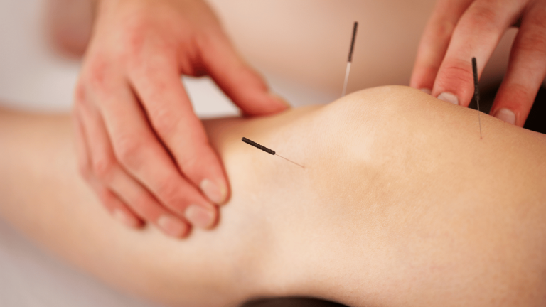 acupuncture atma