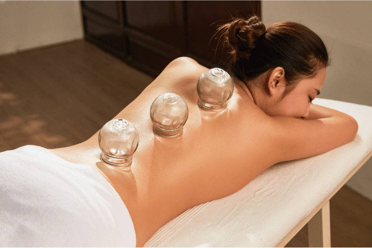 A woman receiving cupping therapy with a glass of water on her back. atma acupuncture